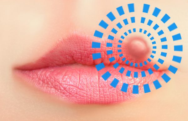 An image of a mouth with a cold sore on it and blue lines highlighting the cold sore to promote the medicated patches with olive leaf extract to treat herpes simplex from Frequency Apps.